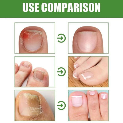 Nail Shield™ Anti-Fungal Roll-On – 10ml
